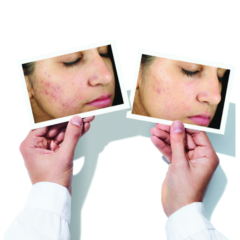 Invisiscar Resurfacing Treatment