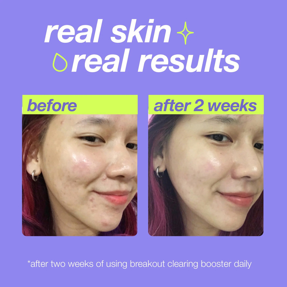 Breakout Clearing Booster, 30ml